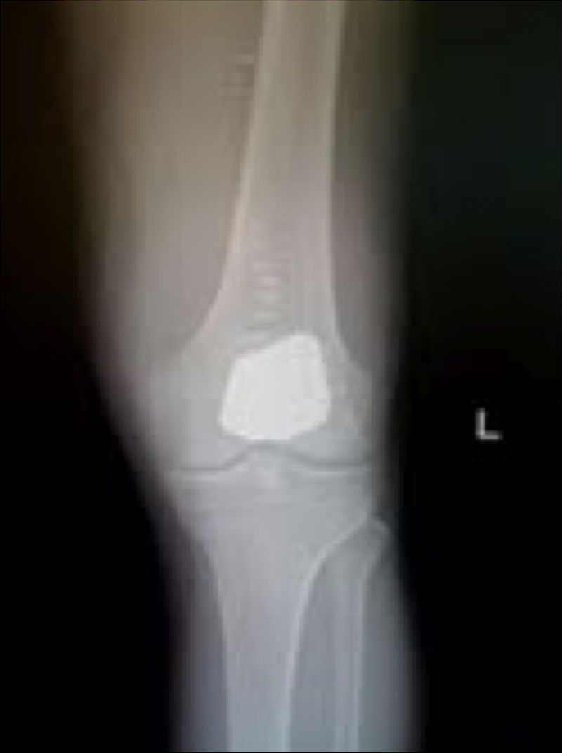 Knee Prostheses:  Patellofemoral:  MAKO (Implant 4235)